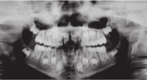 After 6 months, the deviation was reduced to the width of 1 mandibular tooth.