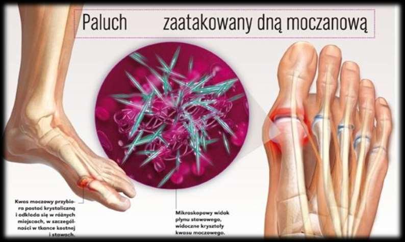 Zapalenie stawów spowodowane krystalizacją i fagocytozą moczanu