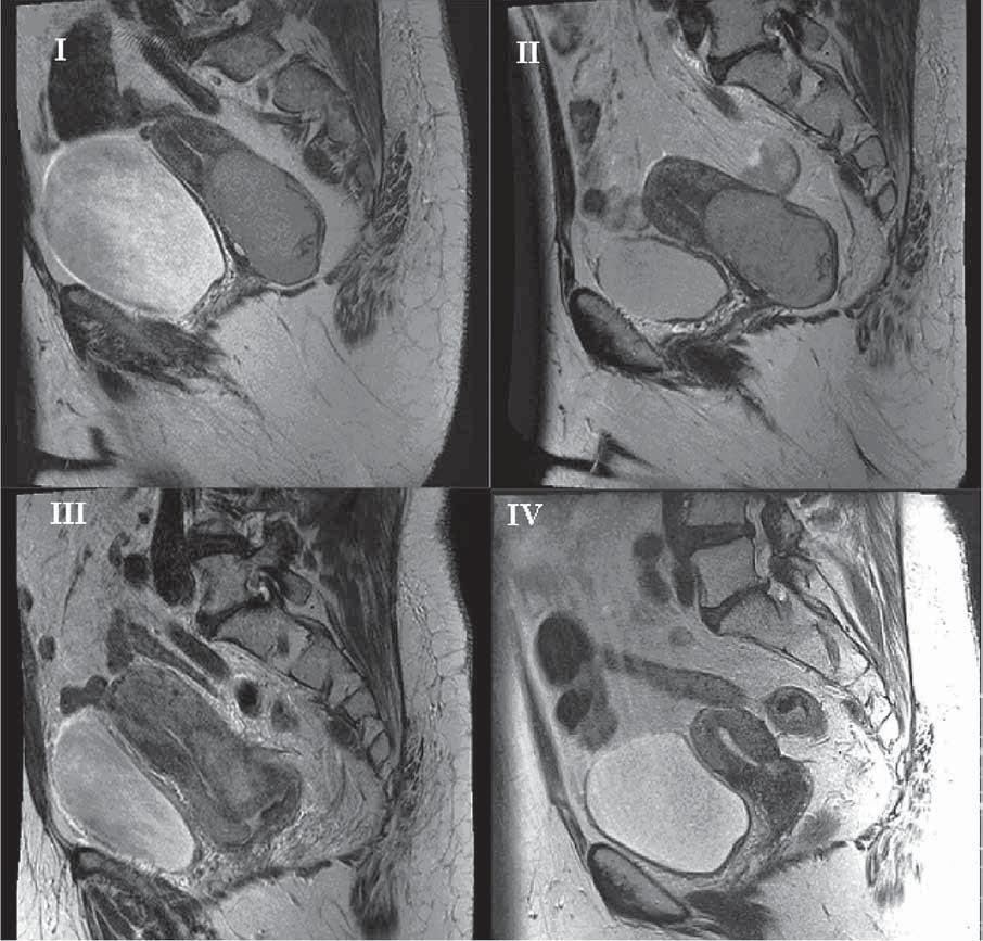 P R A C E K A Z U I S T Y C Z N E Figure 1. Sagittal T-2 weighted MR (I - 02.03.2011; II - 06.05.2011; III - 22.07.