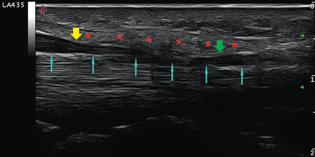 High-frequency ultrasound in carpal tunnel syndrome: assessment of patient eligibility for surgical treatment Material and methods Materiał i metoda The study involved 62 patients (50 women and 12