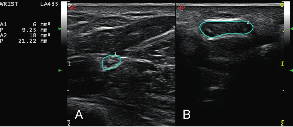 Katarzyna Kapuścińska, Andrzej Urbanik cross-sectional area of the nerve is lower at the compression level, the echogenicity is higher and the honeycomb appearance is not observed.