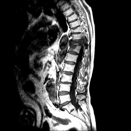 Ryc.1 Badanie MRI kręgosłupa Th-LS - materiał własny Kliniki Neurochirurgii, Neurotraumatologii i Neurochirurgii Dziecięcej Szpitala Uniwersyteckiego nr 1 im. dr A. Jurasza w Bydgoszczy, CM UMK.