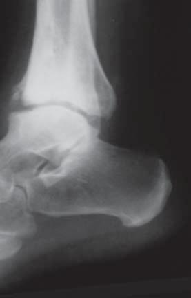 Ankle joint arthroscopy: indications and real expectations of the talocrural joint (Pic.1).