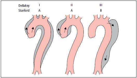 Rysunek 3 Klasyfikacja rozwarstwienia aorty wg Klasyfikacji DeBakeya i Klasyfikacji Stanford (Źródło: Kardiologia Medycyna Praktyczna, http://kardiologia.mp.