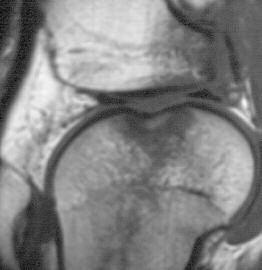 Badanie obrazowe w diagnostyce chrzåstki stawowej Fot..39. Osteochondritis dissecans kæykcia przy rodkowego k. udowej Fot. 37.