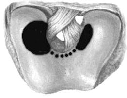 Acta Clinica Ultrasonografia chrzåstki stawowej kolana Ze wzglædów morfologicznych ogranicza siæ do diagnostyki powierzchni kæykci k. udowej. Powierzchnie zarówno k.