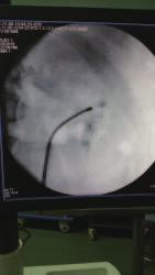 Przy większych fragmentach, które zmieszczą się w pochewce ClearPetra, ale są zbyt duże, aby przedostać się przez przestrzeń między endoskopem a pochewką ClearPetra, należy powoli wycofać endoskop