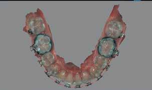 ZREWOLUCJONIZOWANA CYFROWA ORTODONCJA Możesz uprościć proces akwizycji modeli cyfrowych lub ortodontycznych z nowym intuicyjnym oprogramowaniem.