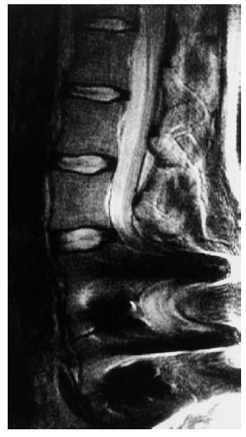 Artefakty spowodowane obecnością metalu Clinical MR Imaging, A practical