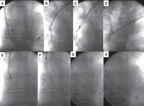 Odelektrodowe zapalenie wsierdzia jako późne powikłanie po implantacji stymulatora serca 267 Rycina 1.