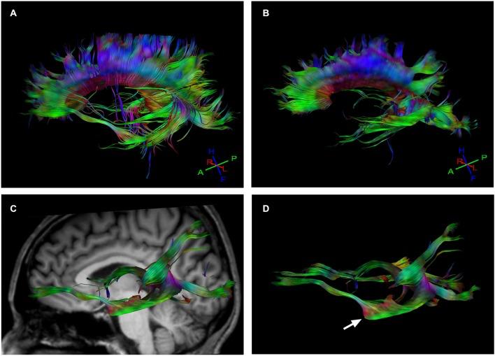 Hearing colors: an example of brain plasmcity.