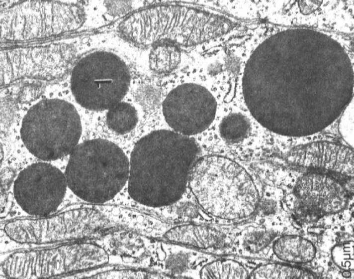 wtręty krystaliczne i parakrystaliczne ziarna barwników melanina lipofuscyna