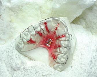 Ze względu na śnieżnobiały kolor szczególnie nadaje się do prac ortodontycznych. Modele wykonane z tego gipsu charakteryzują się gładką i wytrzymałą na ściskanie powierzchnią.