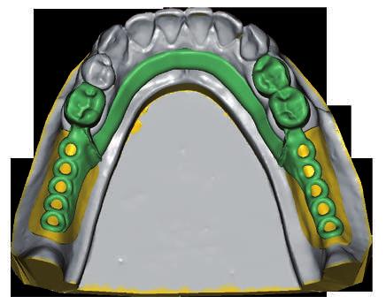 SilaPart CAD Program do projektowania szkieletów Moduł do projektowania teleskopów Program do projektowania szkieletów: doskonała pasowność, najwyższa jakość powierzchni oraz regulowana