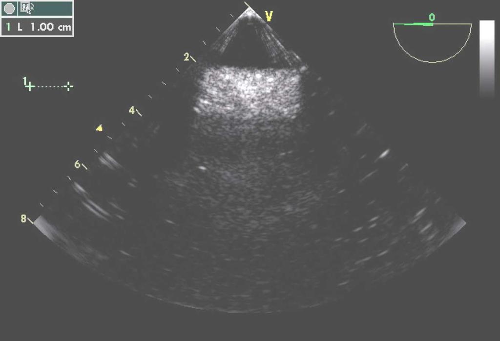 multiple echos (ultrasound), Barrel