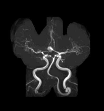 Rycina 1. Angiografia rezonansu magnetycznego. Tętniak tętnicy łączącej przedniej śr. 9 mm, MD, lat 50 (materiał własny autora) Rycina 2. Angiografia klasyczna weryfikacja badania z ryciny 1.