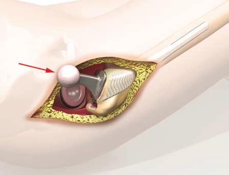 Odpowiedni trzpień należy nakręcić na instrument do osadzania trzpienia z uchwytem śrubowym i osadzić w przygotowanym łożu implantu (ryc. 40).