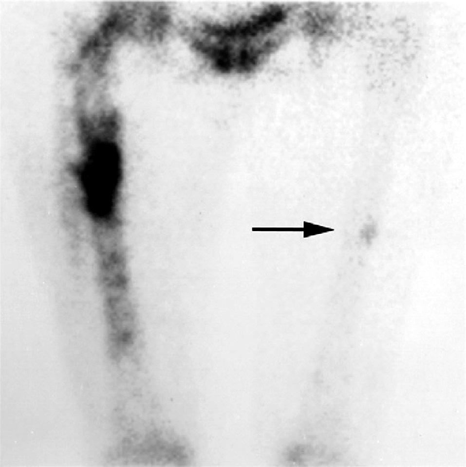 A female patient, 55 years old, treated with alendronate for 5 years. On the right side, typical, short oblique fracture, and on the left side, cortical thickening are visible.