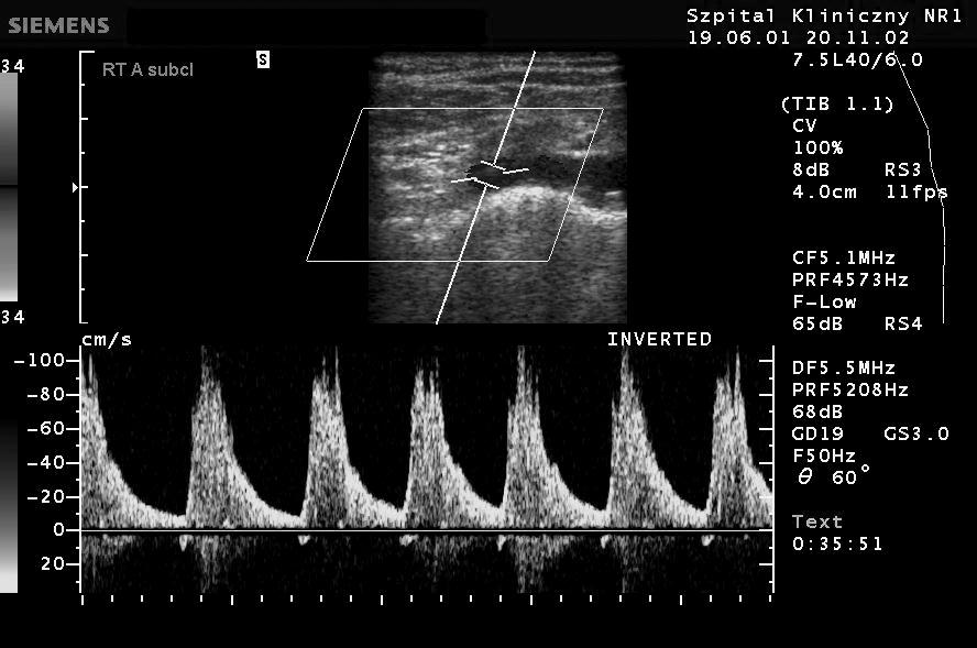 Acta Angiol., 2005, Vol. 11, No. 4 A B Figure 1. Case no. 1 upward flow in the internal carotid arteries; A.