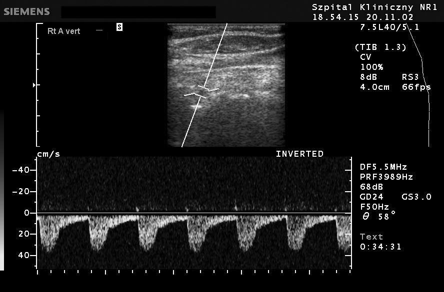 arteries, the posterior cerebral arteries and the basilar artery.