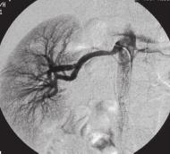 nadciśnienie tętnicze rok 2006, tom 10, nr 2 B C A Rycina 2. Badanie DSA tętnic nerkowych. A. niedrożność tętnicy nerkowej prawej; B. stent wszczepiony przez podział tętnicy nerkowej.