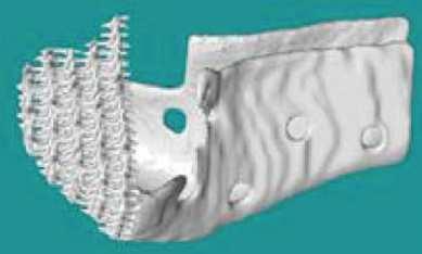 Zastosowanie metod Rapid Prototyping w procesie kształtowania skomplikowanych struktur kostnych Rys. 4. Model wykonany w technologii SLS [4] Fig. 4. Model made with SLS technology [4] 2.