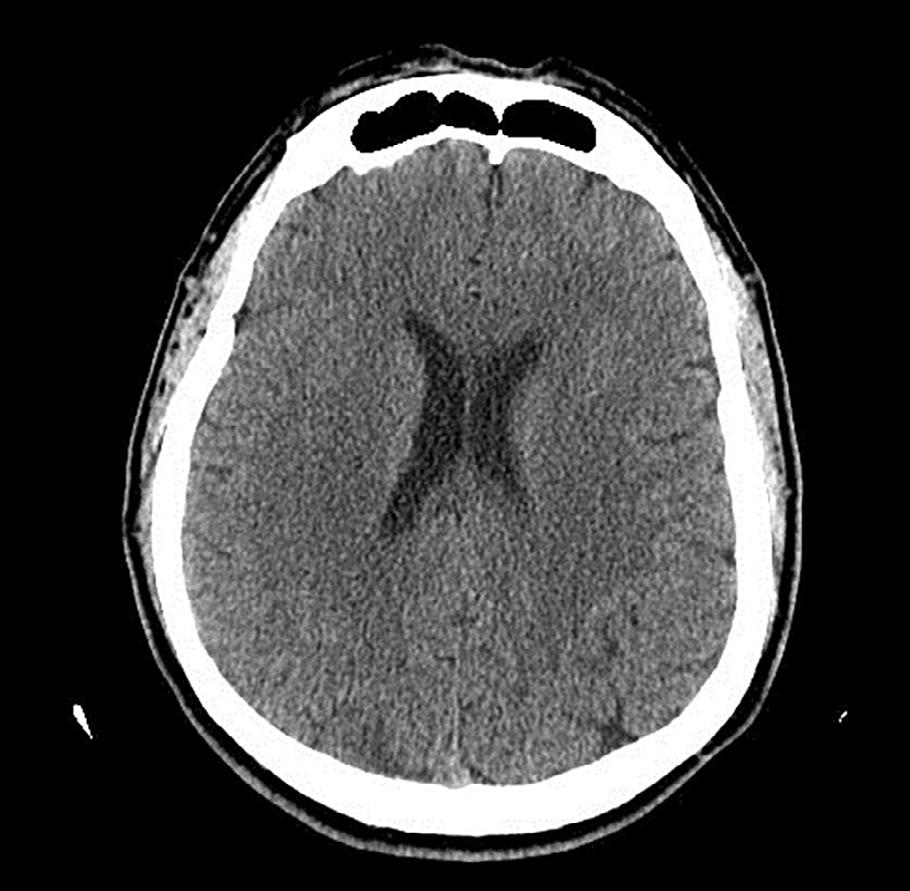 Polski Przegląd Neurologiczny, 2016, tom 12, nr 1 obniżenia ciśnienia wewnątrzczaszkowego oraz zwiększenia ciśnienia perfuzyjnego.