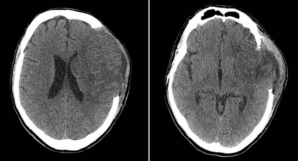 Magdalena Kowalska i wsp., Hemikraniektomia u pacjenta ze złośliwym obrzękiem mózgu A B Rycina 5A, B. Tomografia komputerowa (TK) mózgu, badanie w 14.
