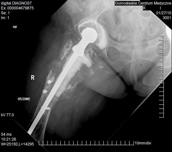 Zaopatrzenie rozległych ubytków kości udowej po: zakażeniach okołoprotezowych urazach