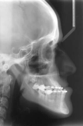 Severe Dentofacial Deformity 85 Fig. 4.
