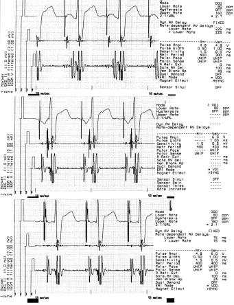Folia Cardiol. 2001, tom 8, nr 3 II R CS B II R CS C II R CS Ryc. 9.