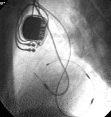 Fig. 4. Chest X-ray of the patient with biatrial pacing system based on standard DDD pacemaker. Both atrial leads are directly connected to pacemaker.
