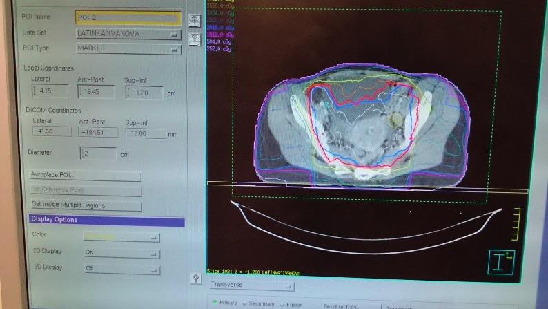 radiologia \ radiology Leczenie EBRT Leczenie EBRT należy dostarczyć zgodnie z obowiązującymi protokołami terapeutycznymi, a wybór techniki powinien być determinowany targetem, obowiązującymi