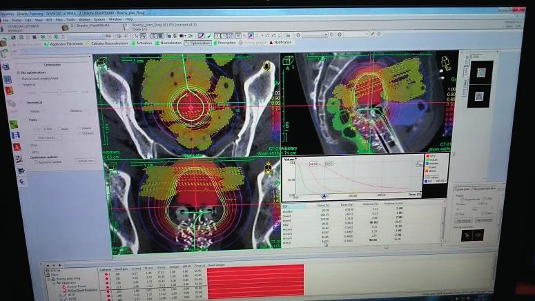 Kontury dla obszarów poddawanych leczeniu radioterapeutycznemu (targetów) są przygotowywane przez lekarza na obrazach TK wykonanych w warunkach wypełnionego pęcherza moczowego.