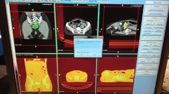 klinicystę do planowania EBRT I i II etapu (Fot. 9, 10).