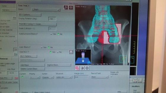 radiologia \ radiology artykuł \ article obliczeń EQD2 dla punktu normalizacyjnego boostu EBRT z