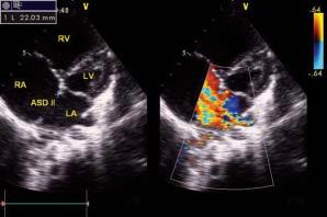 Ubytkom typu sinus venosus zwykle towarzyszy częściowy nieprawidłowy spływ żył płucnych do prawego przedsionka lub żył systemowych (najczęściej żył płucnych prawych do żyły głównej górnej, rzadziej