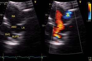 Folia Cardiologica Excerpta 2009, tom 4, nr 6 A B Rycina 3.