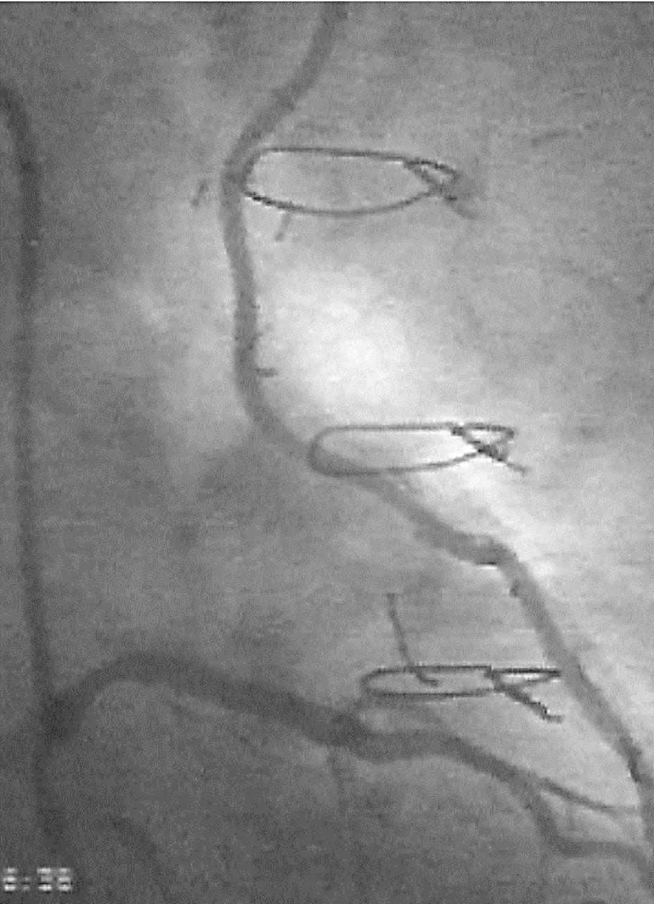 Arteriography of the left coronary artery showing retrograde blood flow to left mammary artery by-pass graft przepływ w lewej tętnicy pachowej, co potwierdziło hemodynamiczną istotność zwężenia lewej