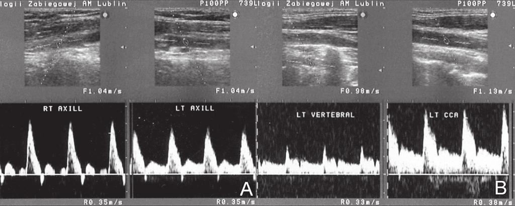 arteriografia po zabiegu z odtworzeniem prawidłowego światła tętnicy podobojczykowej i prawidłowym wypełnianiem się tętnicy kręgowej (C) Figure 3.