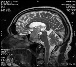 W badaniu neurologicznym, poza niewielką niezbornością lewej kończyny dolnej, nie zaobserwowano innych objawów uszkodzenia układu nerwowego.