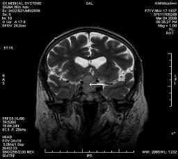 Polski Przegląd Neurologiczny, 2009, tom 5, nr 1 A C B Rycina 2.