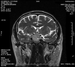 do zatoki jamistej, uciskając jedynie lewą tętnicę szyjną wewnętrzną. Obraz radiologiczny przemawiał za makrogruczolakiem przysadki (ryc. 3A D).