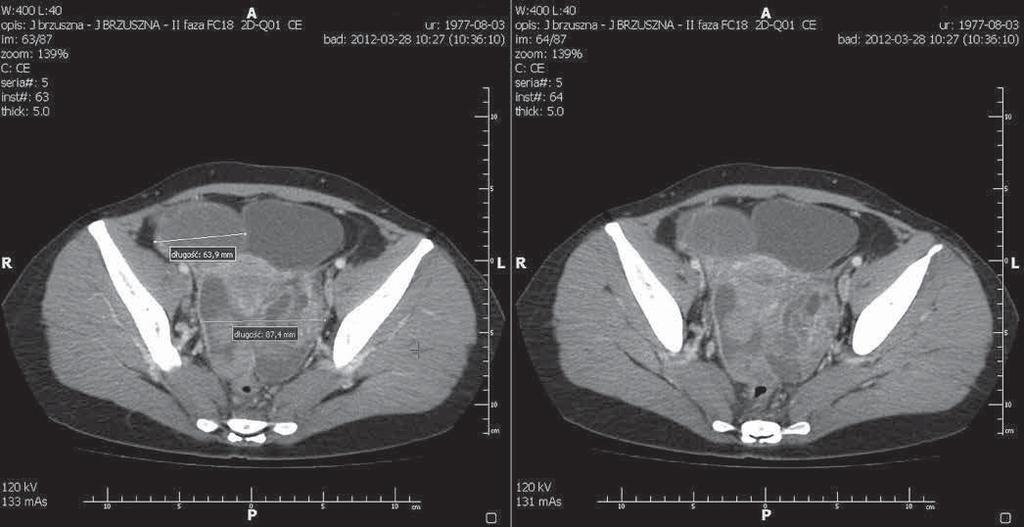 Ginekol Pol. 2013, 84, 465-470 P R A C E K A Z U I S T Y C Z N E Fot. 1. Tomografia komputerowa miednicy mniejszej widoczne zmiany guzowate uciskające struktury miednicy mniejszej (Frozen pelvis).