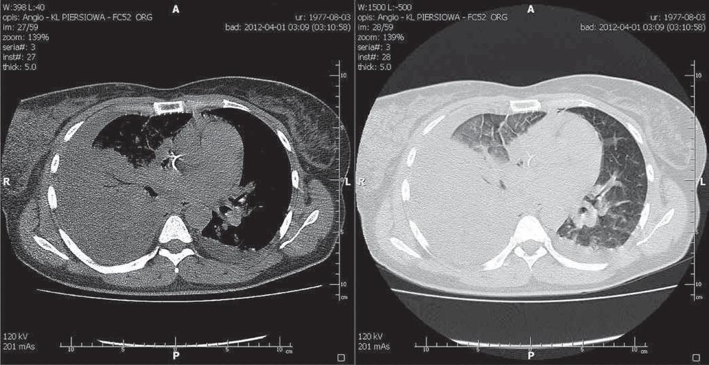 Ginekol Pol. 2013, 84, 465-470 P R A C E K A Z U I S T Y C Z N E Fot. 5. Tomografia komputerowa klatki piersiowej widoczne zmienione zapalnie, częściowo bezpowietrzne płuco prawe.
