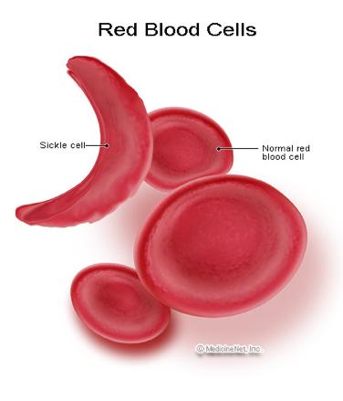 Anemia sierpowata Dobór równoważący