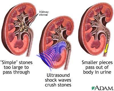 Ultradźwiękowa litotrypsja Litorypsja jest procesem polegającym na rozkruszaniu kamieni nerkowych, żółciowych falą udarową, których fragmenty o wielkości nie przekraczającej 2 mm są wydalane z moczem