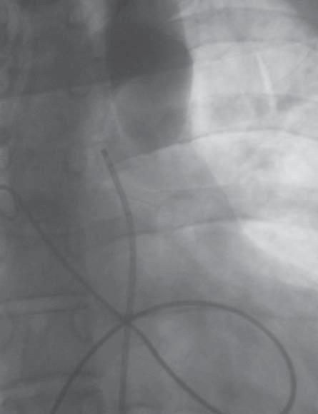 Jacek Kusa i wsp., Odtworzenie ciągłości łuku aorty Rycina 2. W aortografii poniżej cieśni nie uwidoczniono napływu ujemnego kontrastowania Rycina 3.