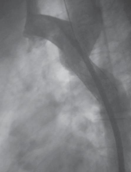Folia Cardiologica Excerpta 2008, tom 3, nr 4 Rycina 4. Aortografia po implantacji stentu Dyskusja Zwężenie cieśni aorty można leczyć chirurgicznie oraz przezskórnie.