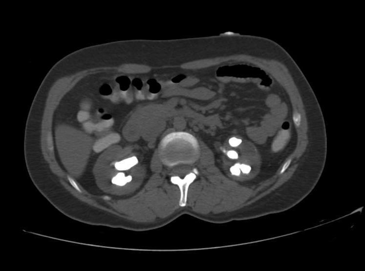 Diagnostyka w ostrym napadzie kamicy moczowej (2) USG jamy brzusznej Liczba leukocytów we krwi, CRP, kreatynina w